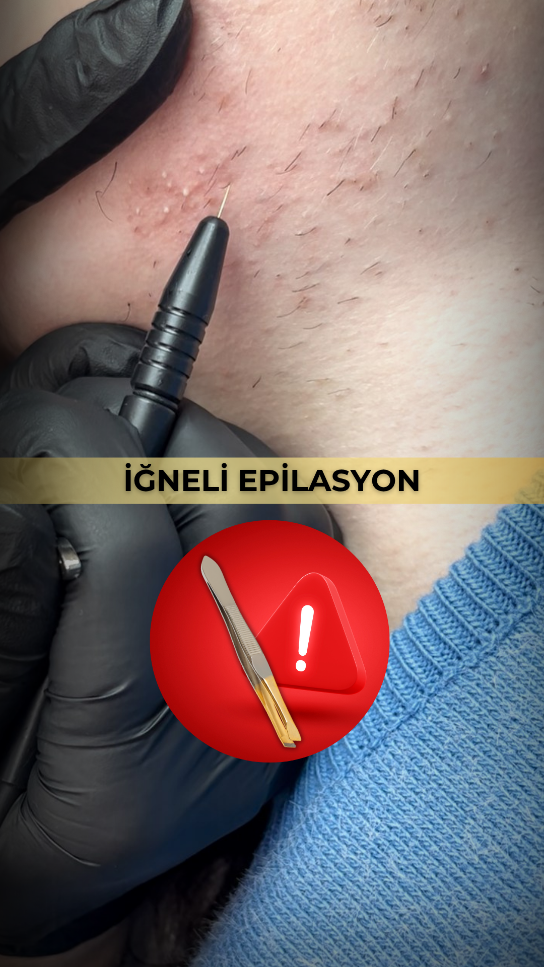 İğneli Epilasyon